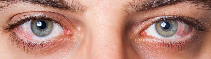 Augenrötungen sind meist die ersten Symptome bei Heuschnupfen